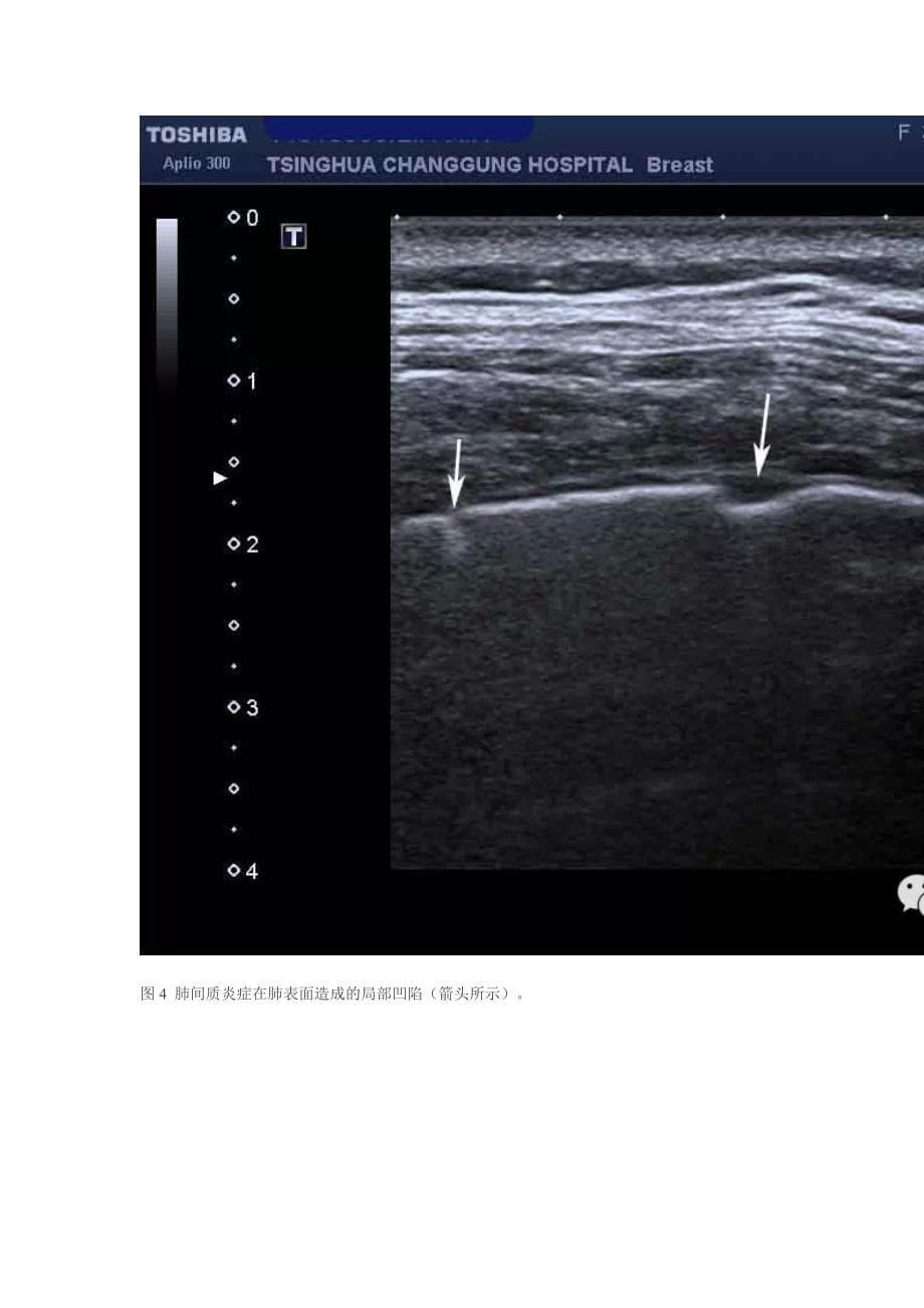 “极光征”：腹部超声检查时的意外发现.doc_第5页