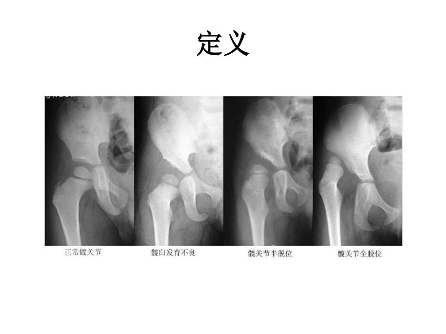 DDH的筛查与超声诊断_第4页