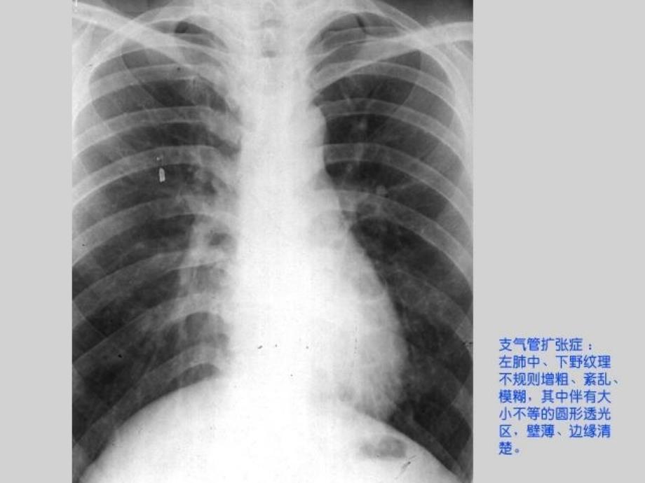 肺部疾病诊断及鉴别诊断集_第4页