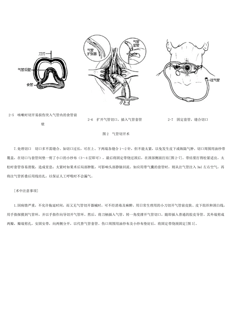 气管切开手术图解.doc_第4页