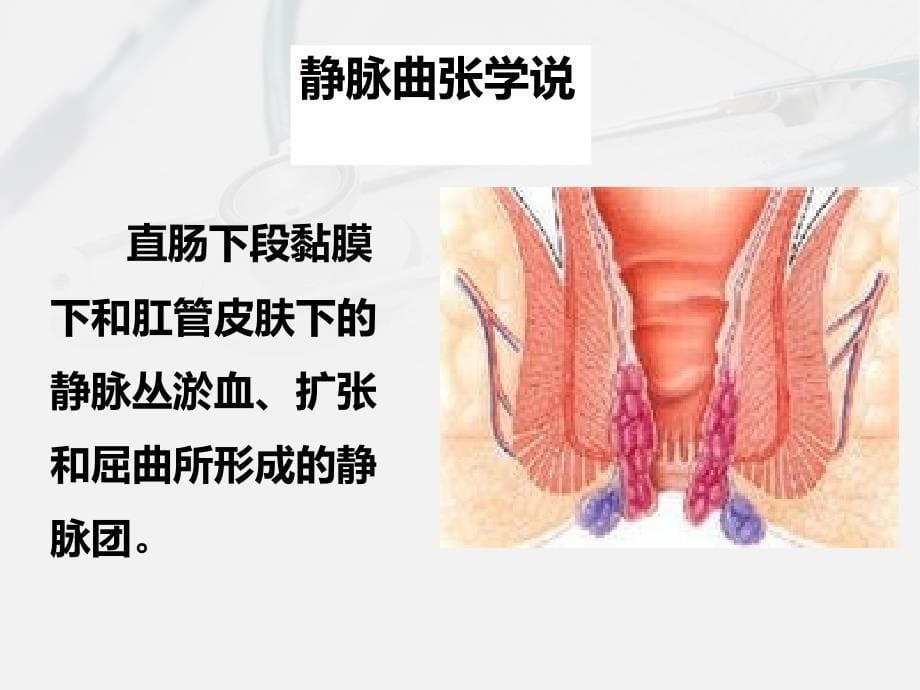 混合痔痔的护理查房ppt课件_第5页