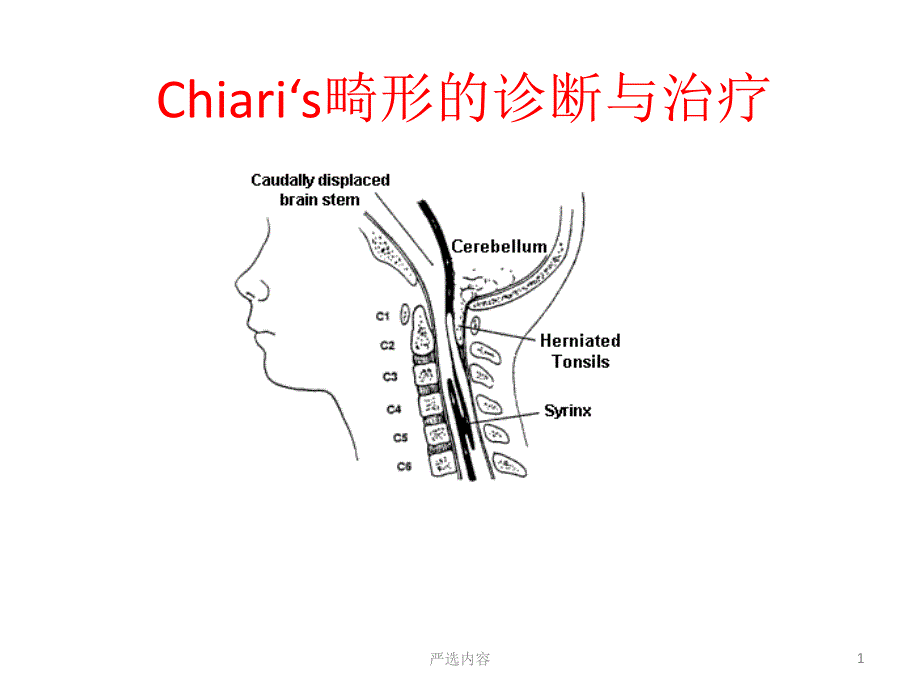 chiari畸形的诊断与治疗优选内容_第1页
