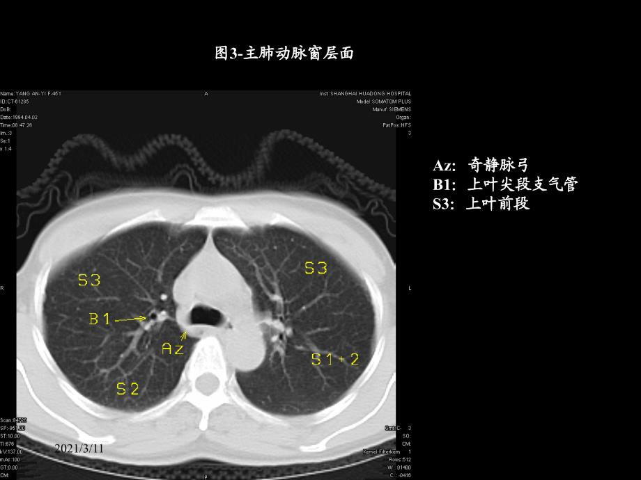 胸部CT的正常结构及肺部疾病的影像学表现_第3页