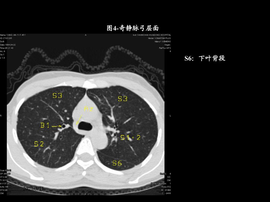 胸部CT的正常结构及肺部疾病的影像学表现_第4页