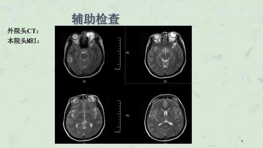 颅内静脉窦血栓形成影像学课件_第4页