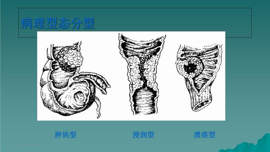 大肠癌病人的护理精选干货_第4页