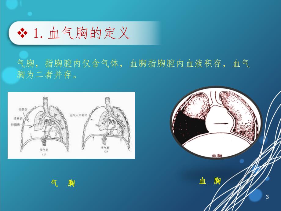 血气胸(课堂PPT)_第3页