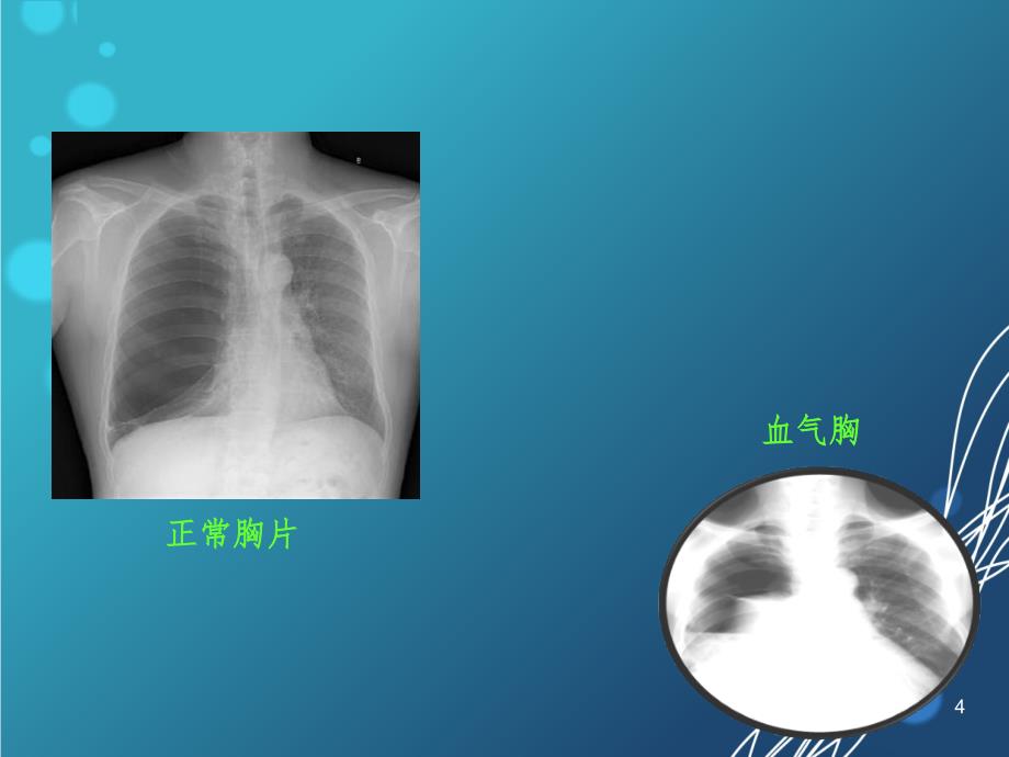 血气胸(课堂PPT)_第4页