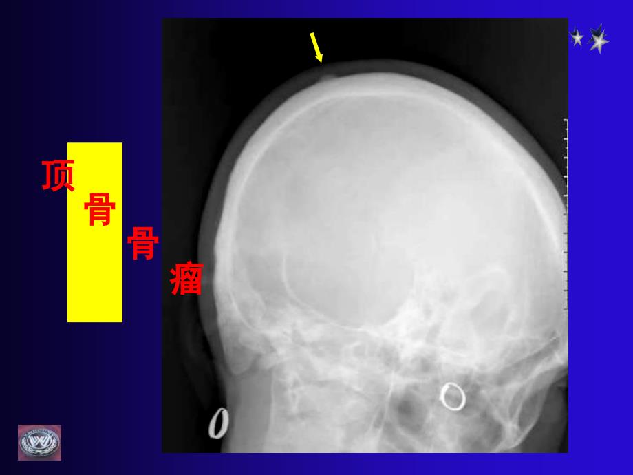 骨肿瘤CT和MRI的影像表现_第3页