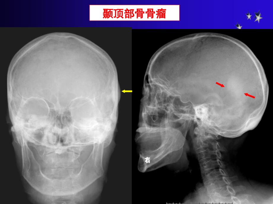 骨肿瘤CT和MRI的影像表现_第4页