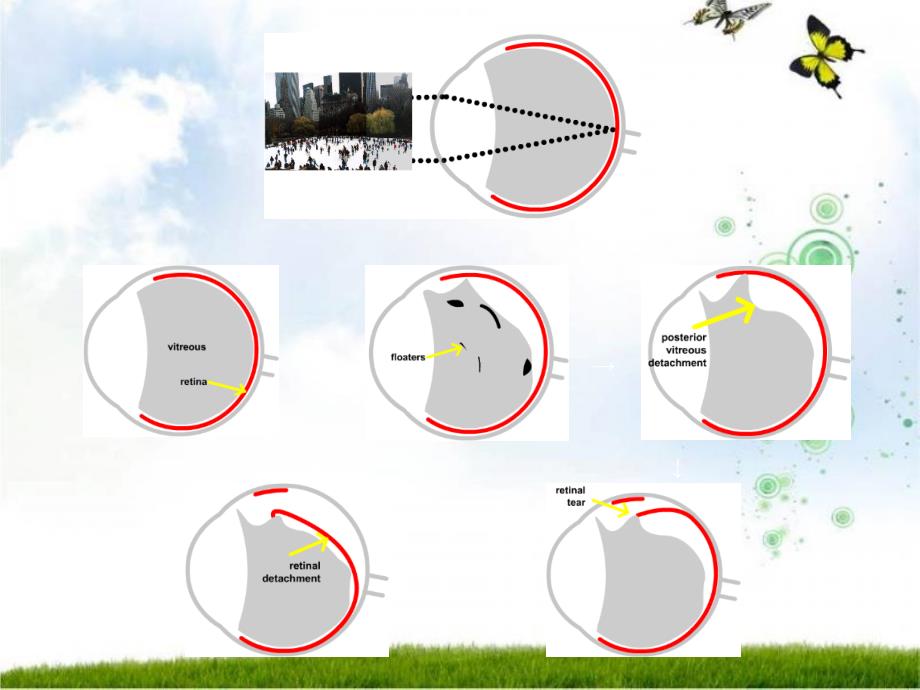 玻璃体疾病ppt课件_第4页