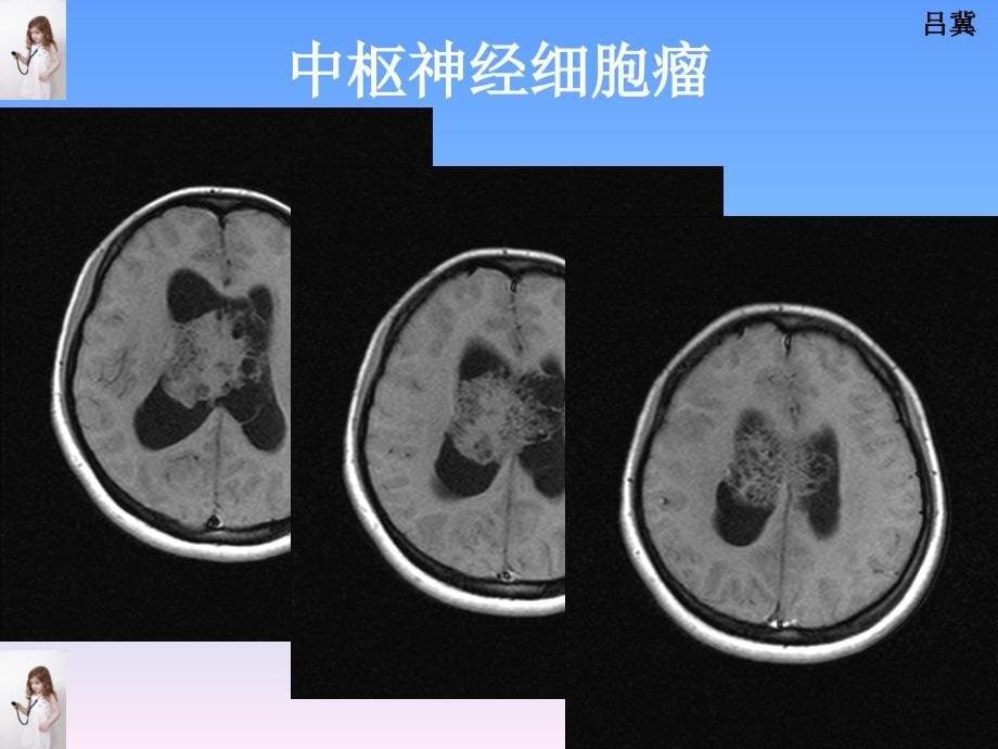 医影在线CNS疾病影像图库1文档资料_第5页