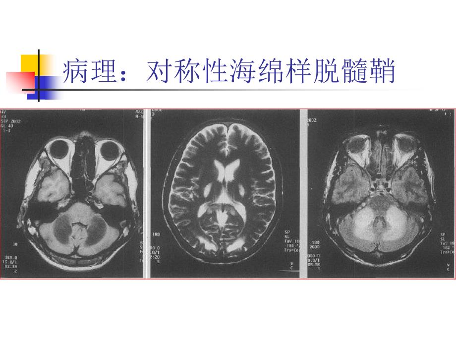 CNS变性-中毒与退行性病变_第4页