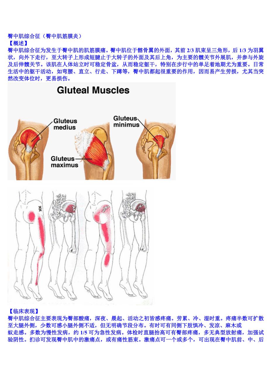 臀中肌综合征(臀中肌筋膜炎).doc_第1页