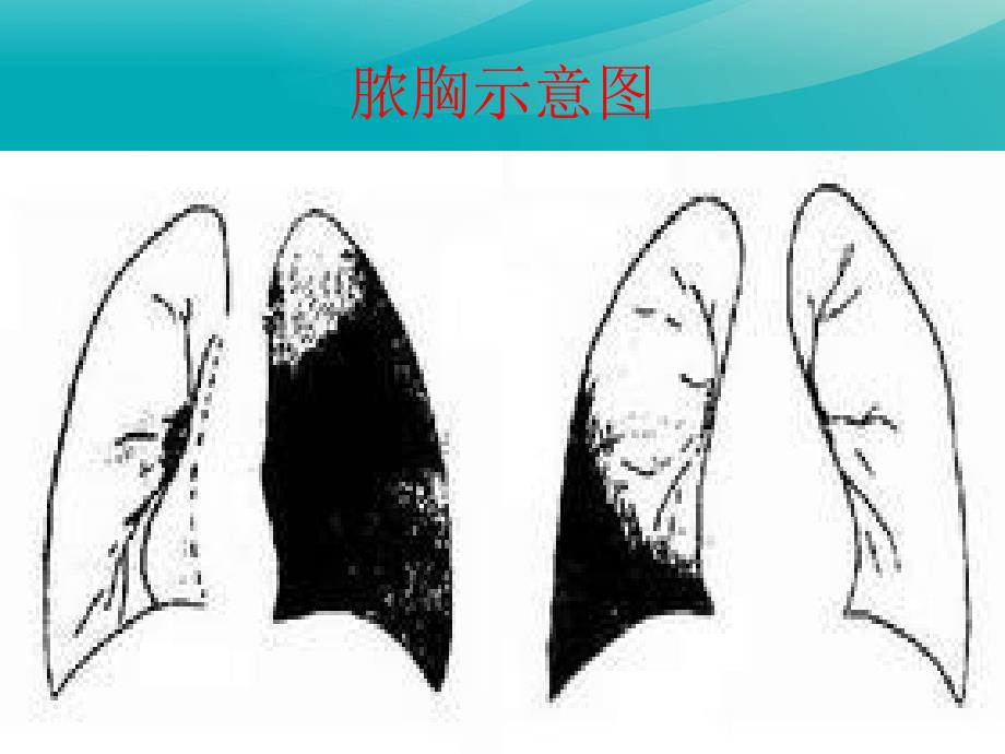 【外科学ppt课件】脓胸、纵膈肿瘤_第4页