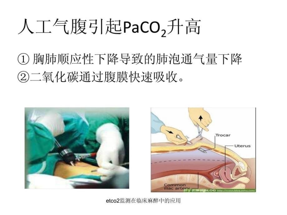 etco2监测在临床麻醉中的应用课件_第5页