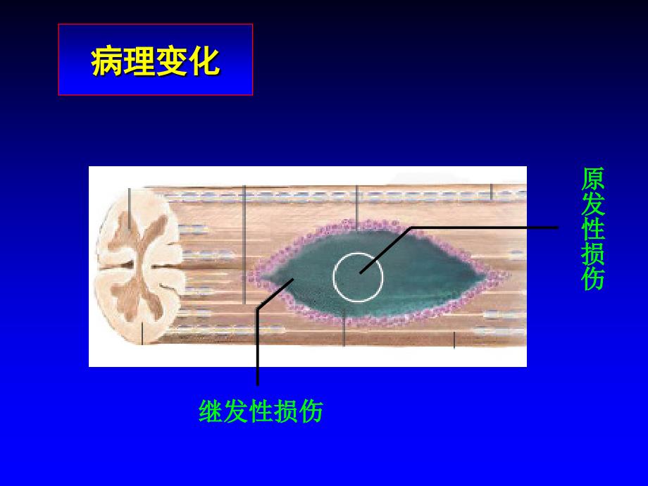 脊髓损伤的治疗及研究进展课件_第4页