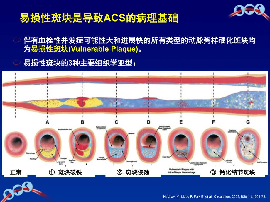 ACS疾病和长期抗血小板治疗的病理基础ppt课件_第3页