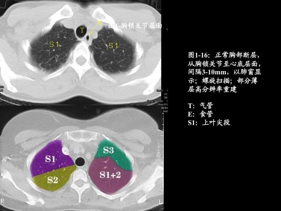 肺部及纵隔ct断层解剖课件.ppt_第5页