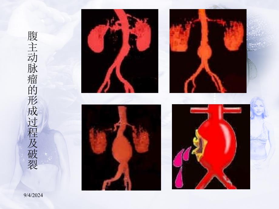 主动脉瘤的影像表现课件_第3页