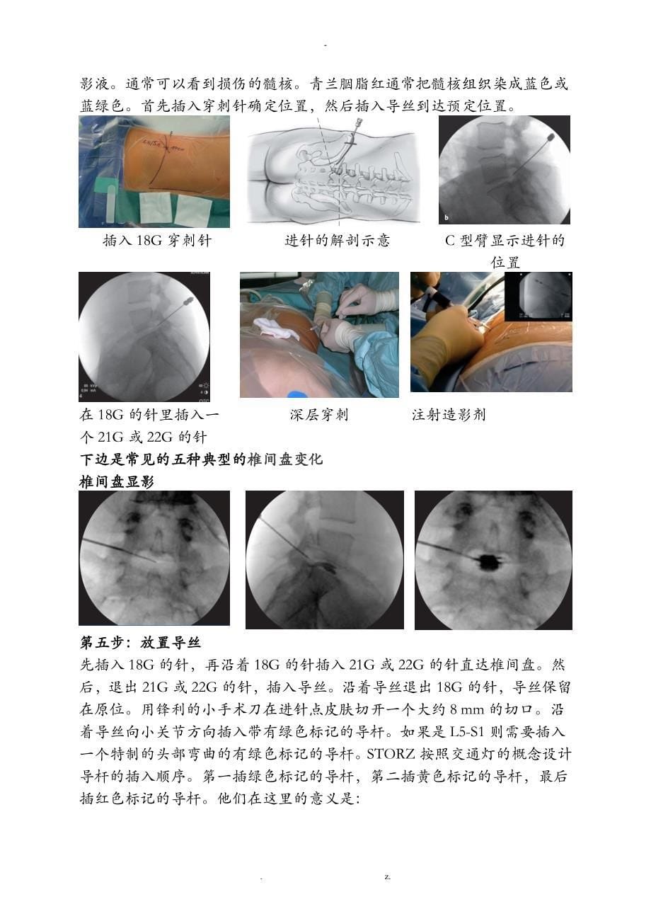 全部步骤椎间孔镜手术范小_第5页