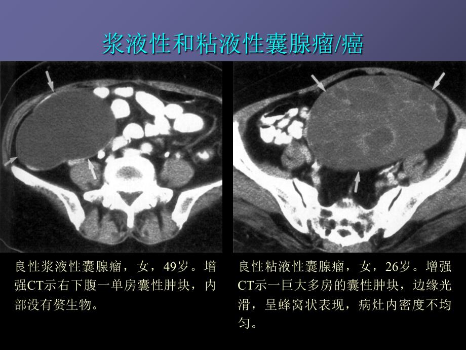 卵巢肿瘤影像诊断及鉴别诊断_第4页