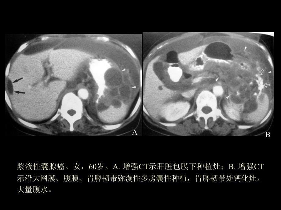 卵巢肿瘤影像诊断及鉴别诊断_第5页