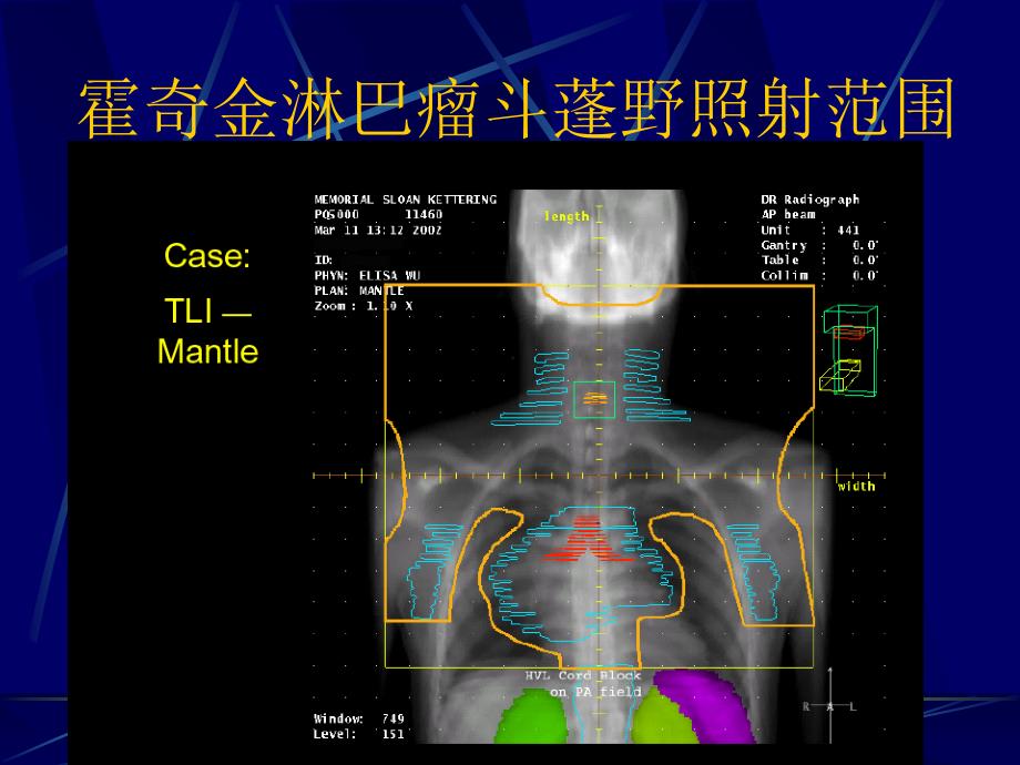 淋巴瘤放疗指南_第4页