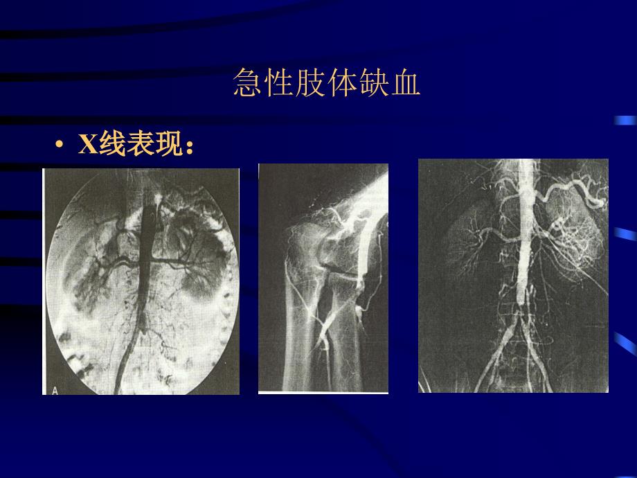 依诺肝素在血管外科的应用_第3页