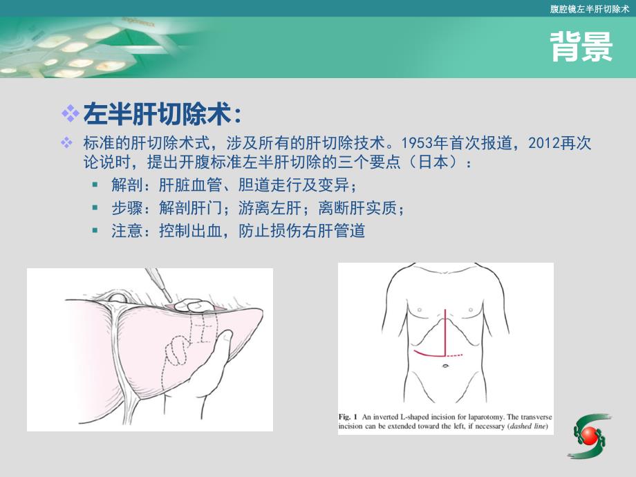 腹腔镜左半肝切除术日趋标准化_第3页