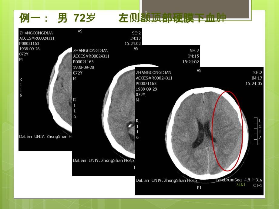 等密度硬膜下血肿的CT征象_第3页