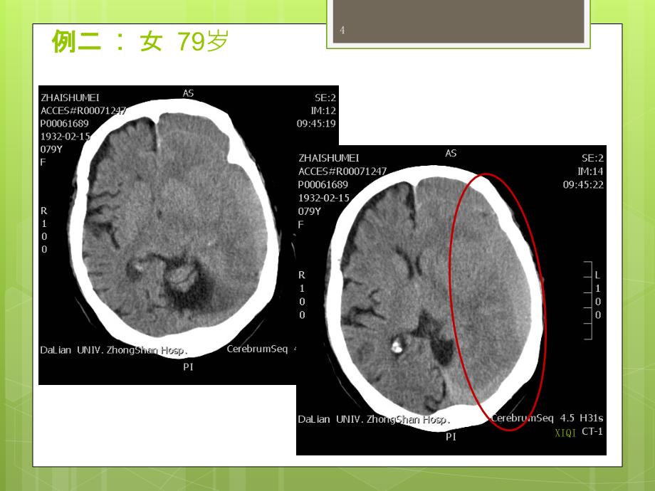 等密度硬膜下血肿的CT征象_第4页