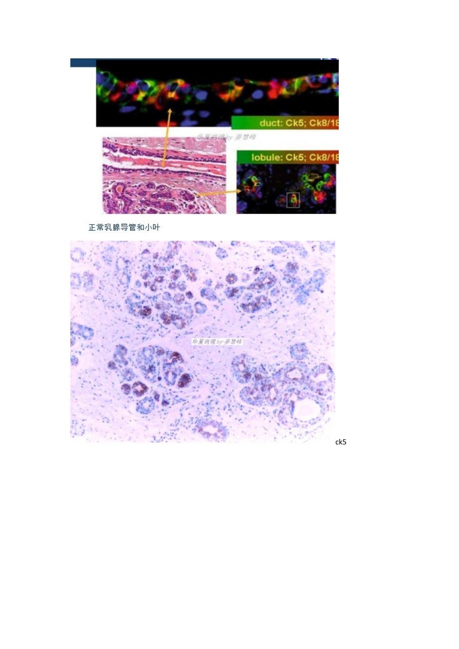 新概念方法解读乳腺导管内增生性病变.docx_第3页