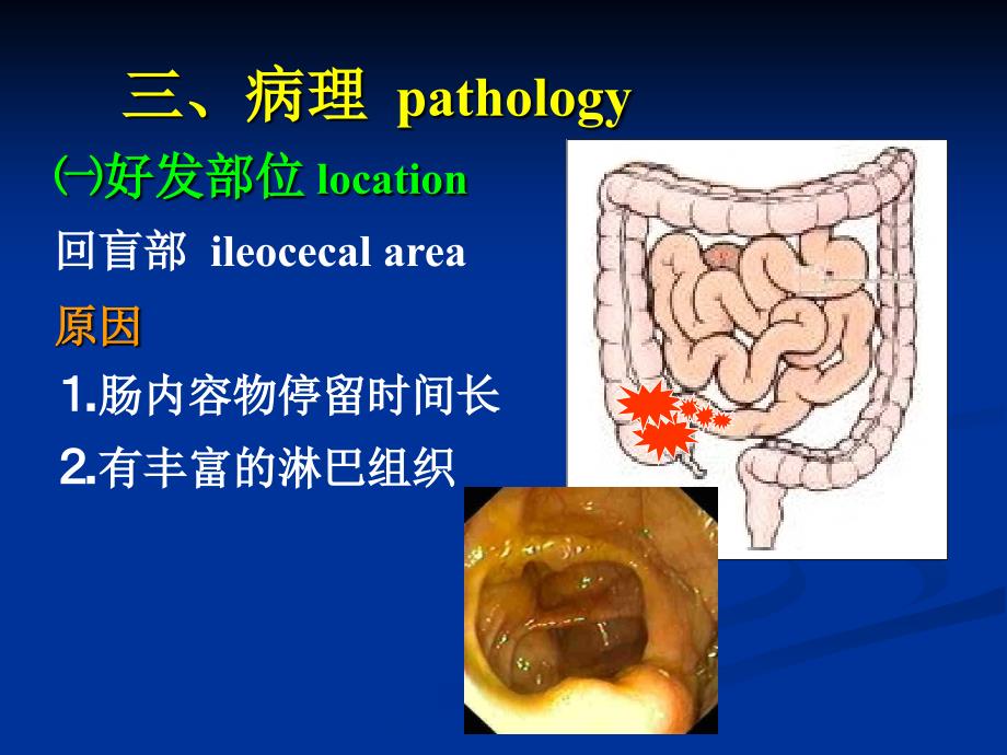 肠结核intestinaltuberculosis_第4页