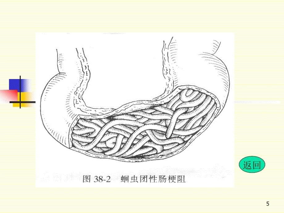 实用肠梗阻PPT课件_第5页