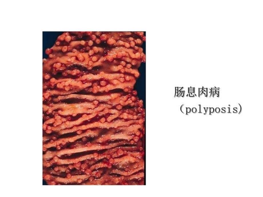 最新医学院大学－－肠息肉、肠息肉病、结肠癌PPT课件_第4页