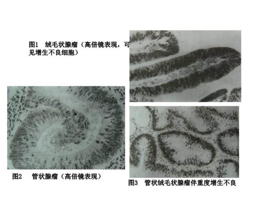 最新医学院大学－－肠息肉、肠息肉病、结肠癌PPT课件_第5页