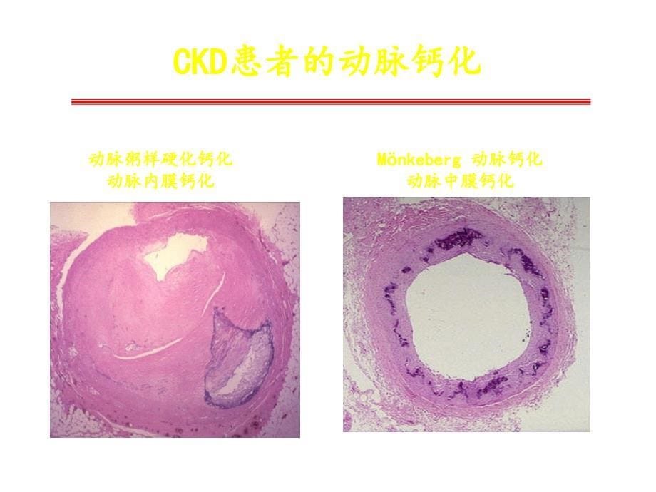 CKD病人血管钙化的防治-_第5页