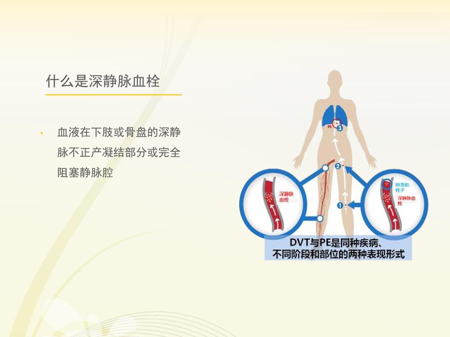 深静脉血栓预防系统课件.ppt_第4页