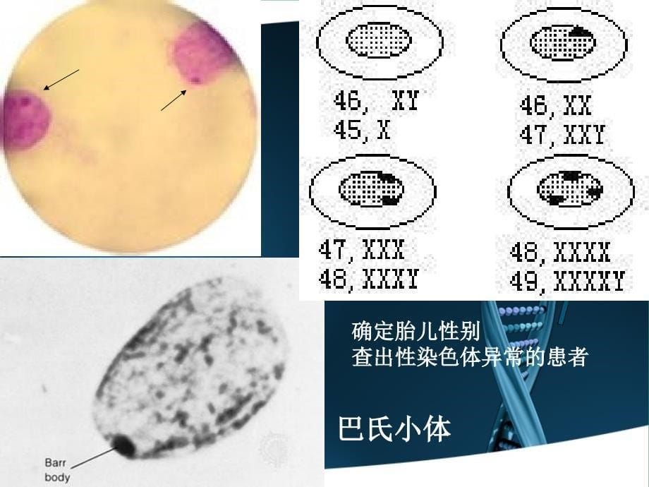 X染色体遗传病_第5页