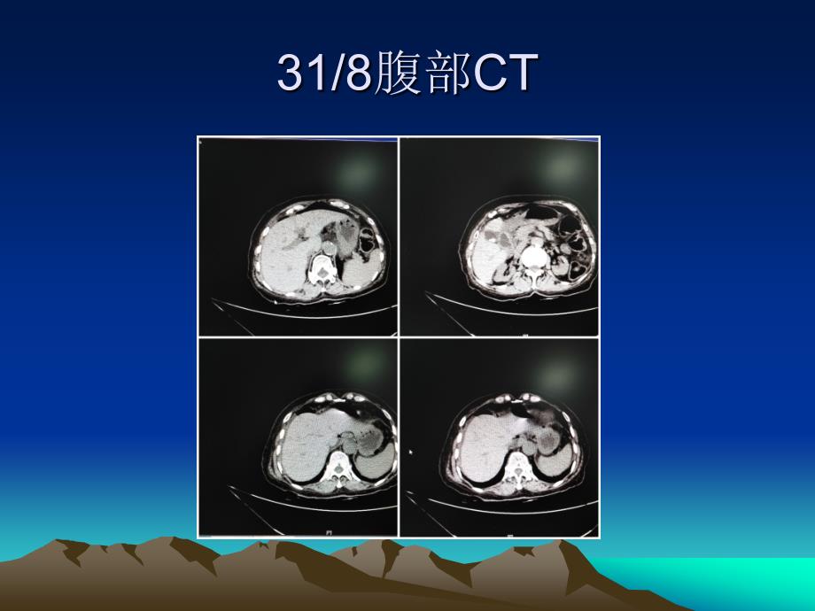 脓毒症病例分享_第4页