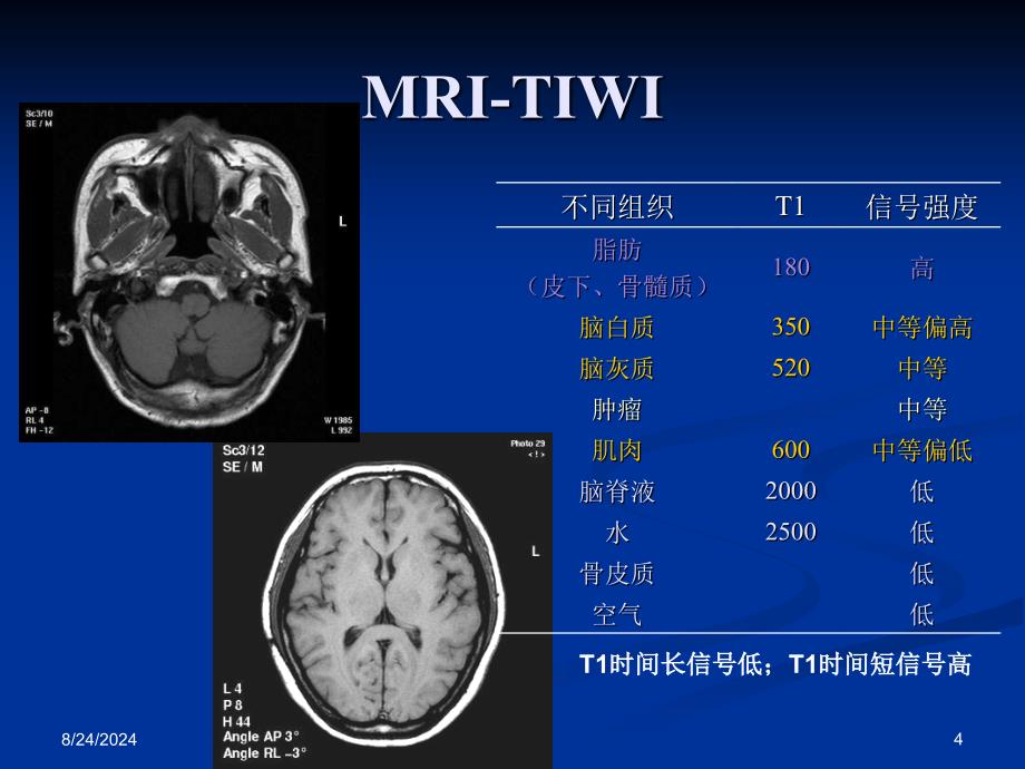 鼻咽癌的CT与MRI诊断_第4页