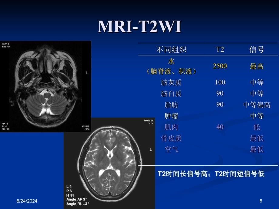 鼻咽癌的CT与MRI诊断_第5页