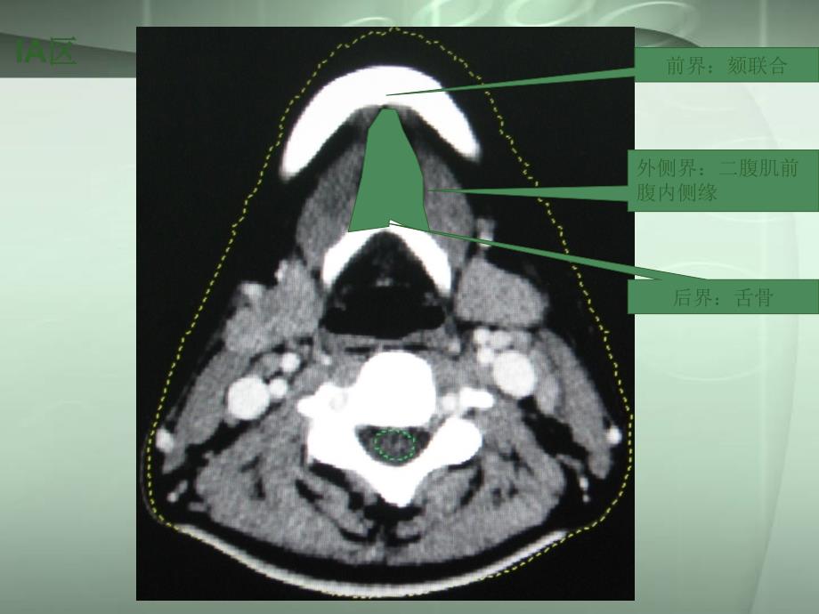 颈部淋巴结病变PPT课件_第2页