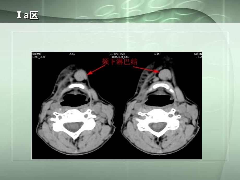颈部淋巴结病变PPT课件_第4页