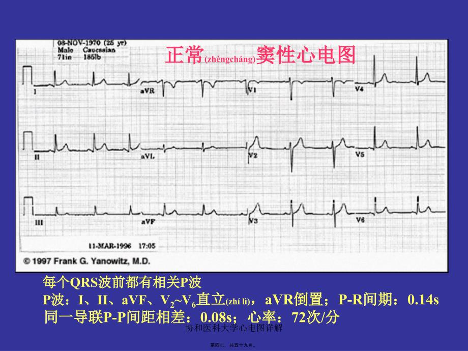 协和医科大学心电图详解课件_第4页