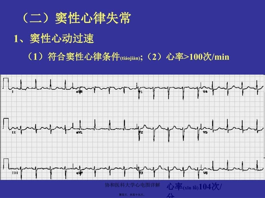 协和医科大学心电图详解课件_第5页