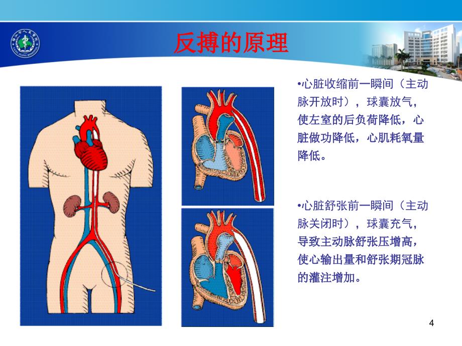 IABP临床应用_第4页