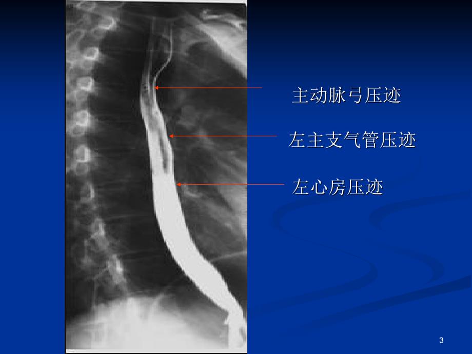 食道癌讲课ppt课件_第3页