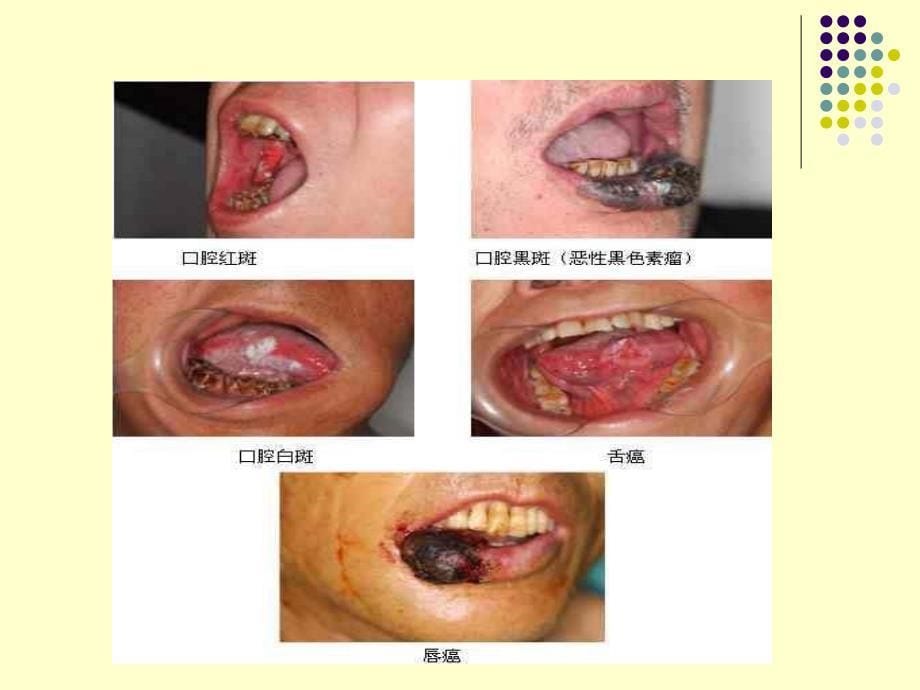 第五章 口腔癌及其预防_第5页